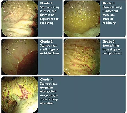 Présentation des grades d'ulcères gastriques chez le cheval